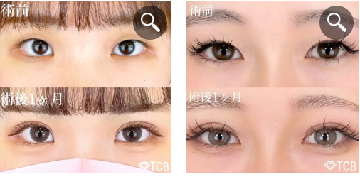 TCB二重術の症例