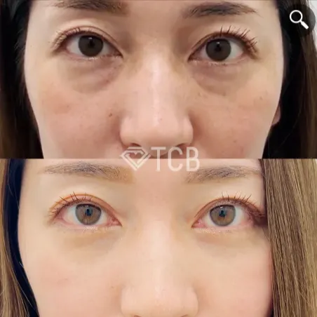 クマ取りの症例