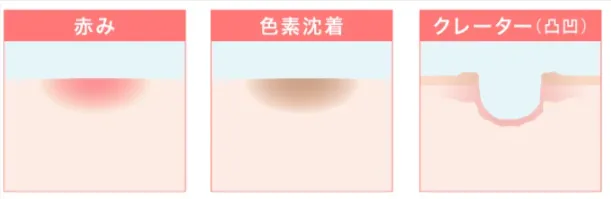 ニキビ跡の種類