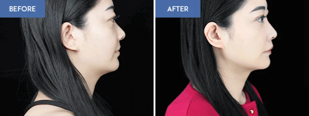 顎下のスルリム注射のビフォーアフター