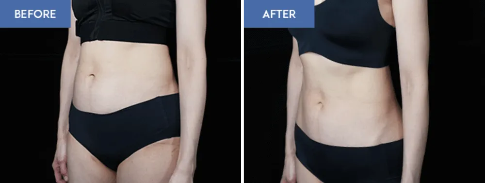 お腹のスルリム注射のビフォーアフター