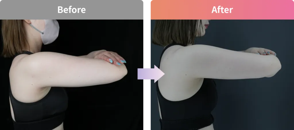 二の腕のスルリム注射のビフォーアフター