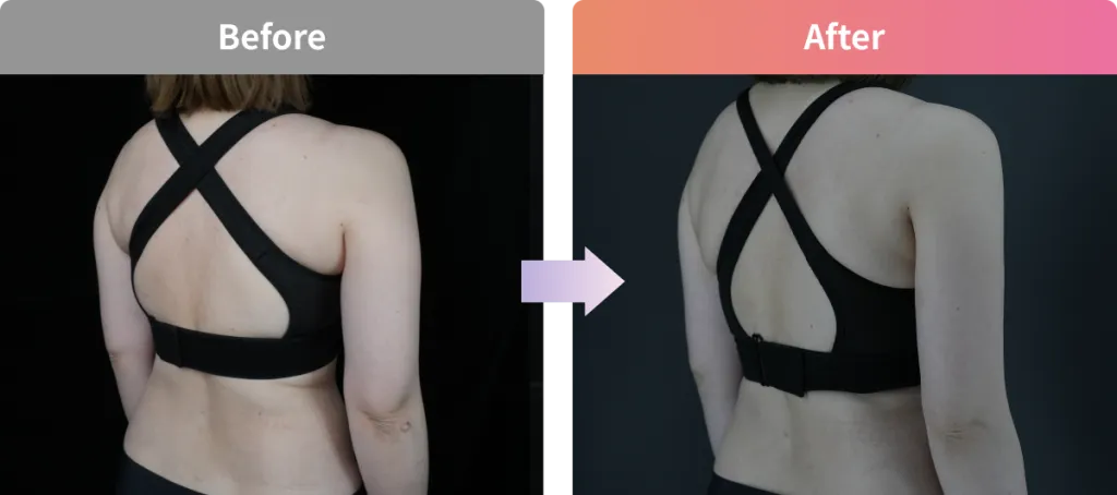 背中のスルリム注射のビフォーアフター