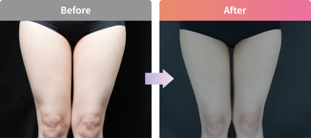 太もものスルリム注射のビフォーアフター