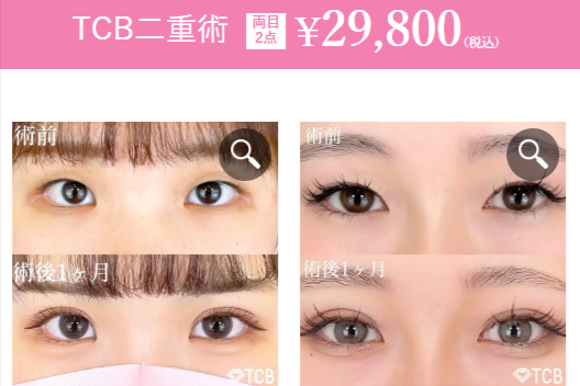 TCB二重術の症例