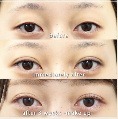 共立美容外科の二重整形の症例