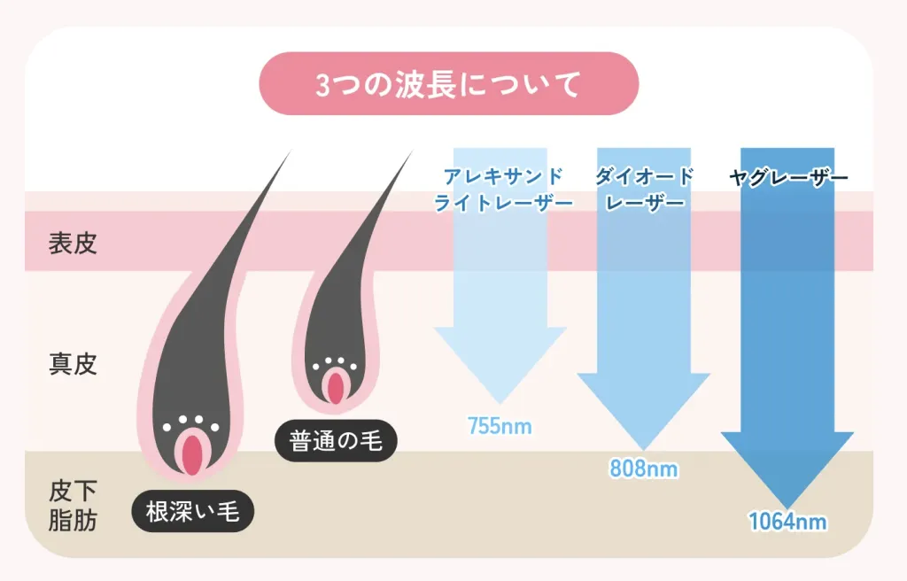 レーザーの種類によって得意な毛質や部位が異なる