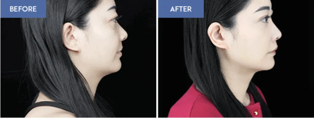 Junoスルリム注射のフェイスラインの症例画像