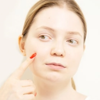 共立美容外科のニキビ跡治療のイメージ