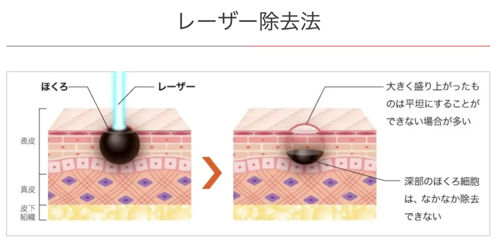 TCB東京中央美容外科のレーザー除去法