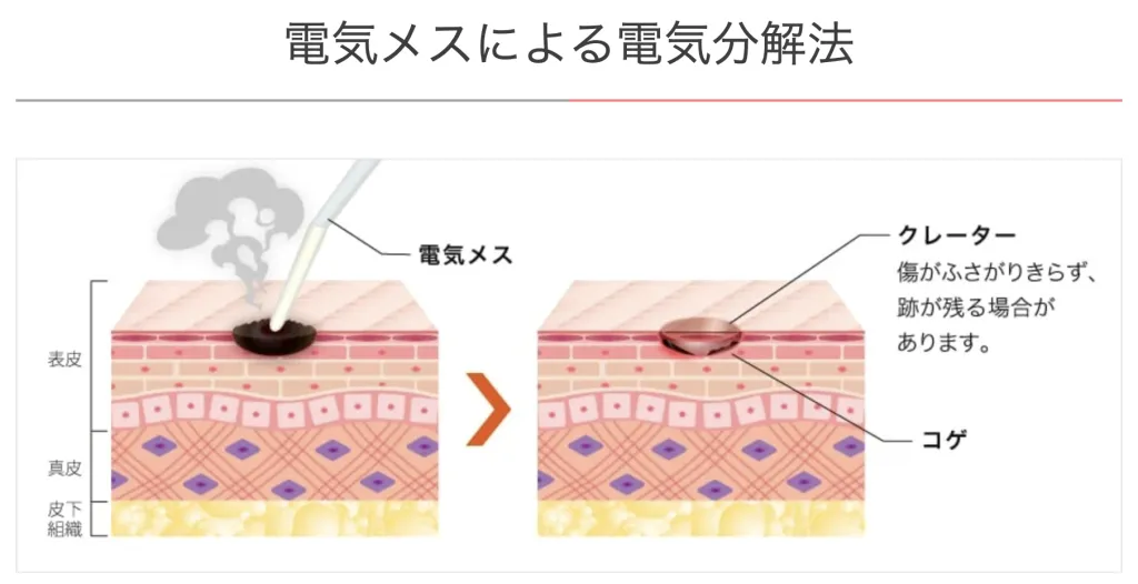 TCB東京中央美容外科の電気メス法