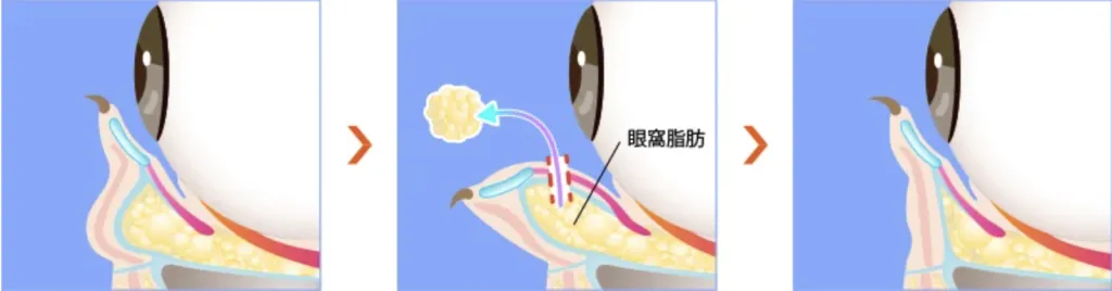経結膜脱脂術のイメージ図