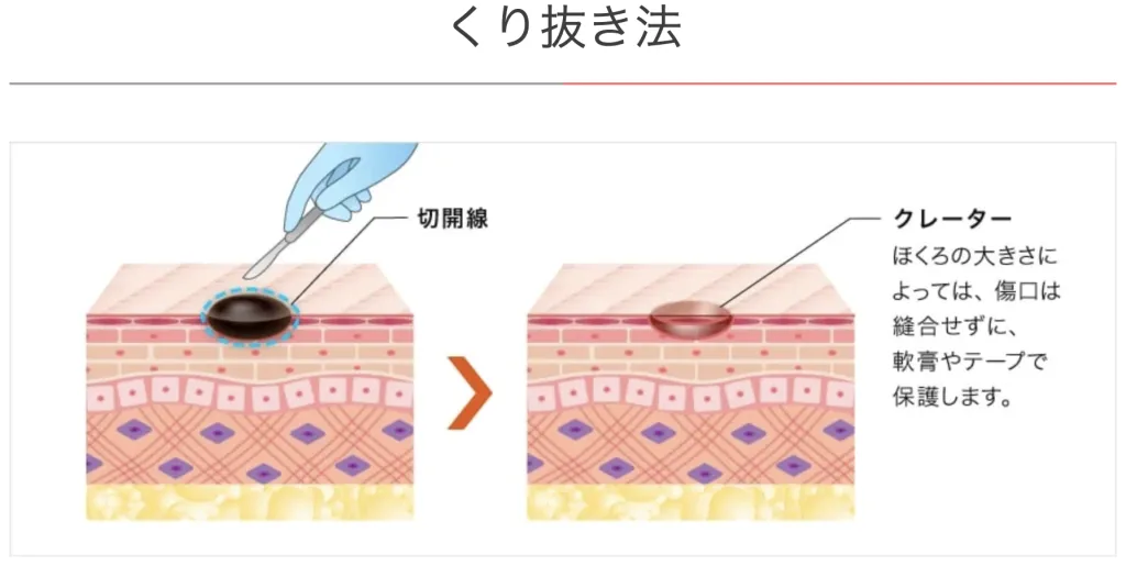 TCB東京中央美容外科のくりぬき法