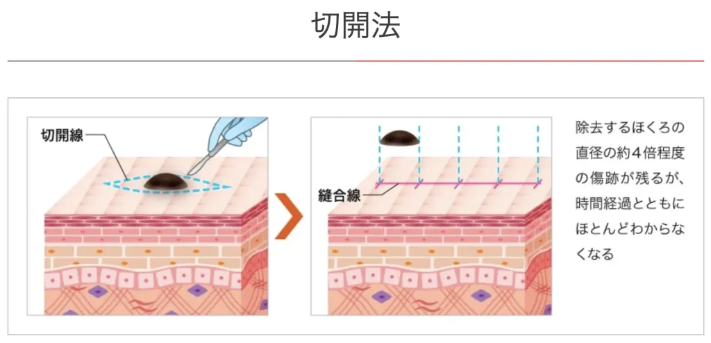 TCB東京中央美容外科の切開法